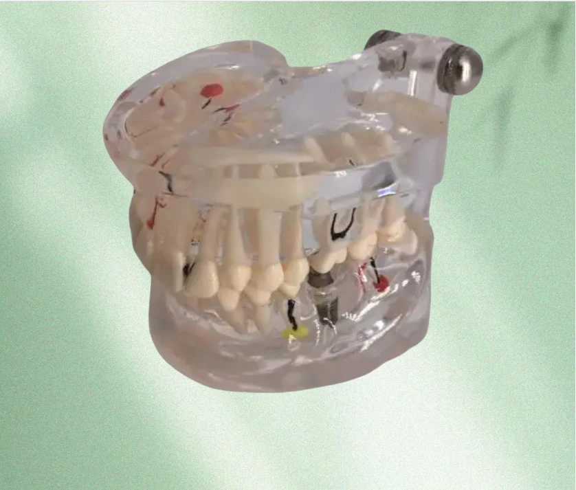 

Медицинская наука модель зуба для взрослых прозрачные патологические модели имплантатов модель полости рта эпоксидная смола бесплатная доставка