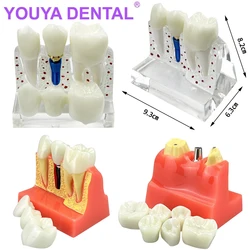 Model dentystyczny 4-krotna analiza implantów dentystycznych Demonstracja mostka koronowego Model zębów dentystycznych Praktyka studencka Studia Tra