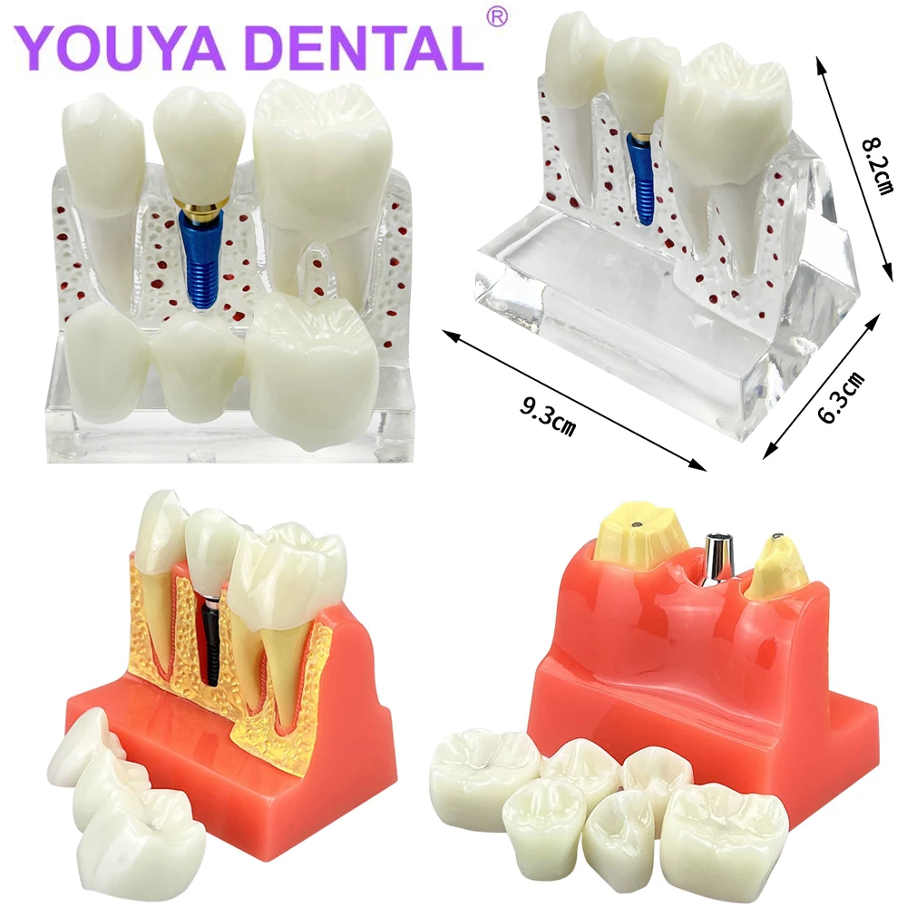 Dental Model 4 Times Dental Implant Analysis Crown Bridge Demonstration Dental Teeth Model Dentist Student Practice Studying Tra