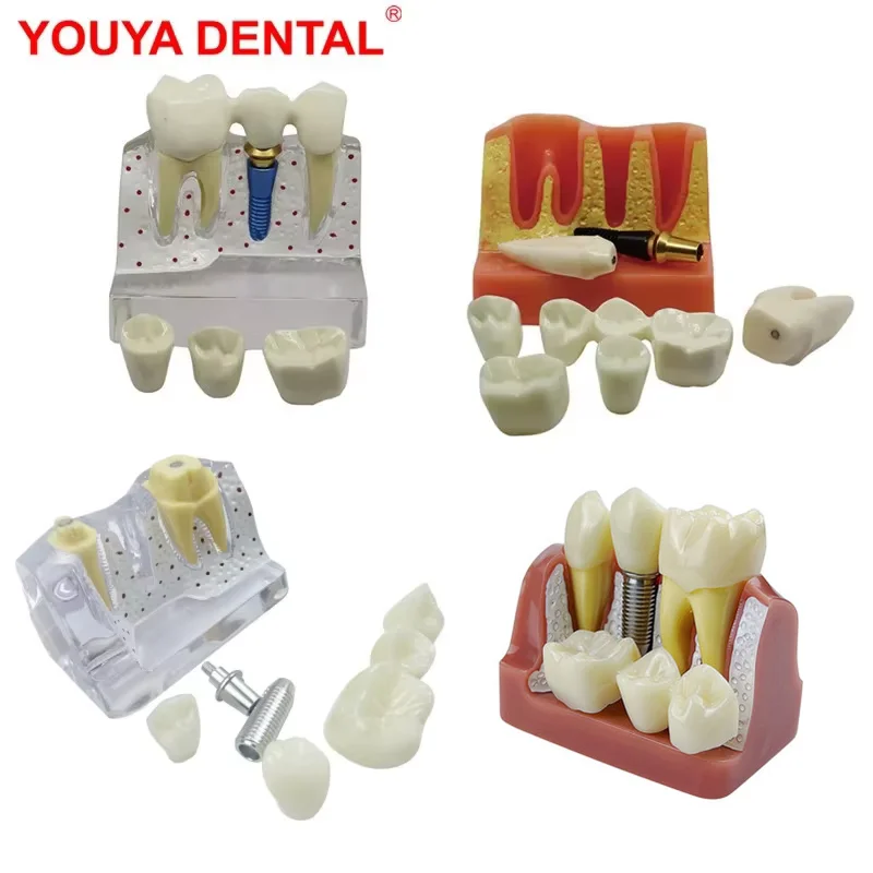 

New 4 Times Implant Dental Model Teeth Teaching Model For Studying Dentist Patient Education Demonstration Dentistry Products