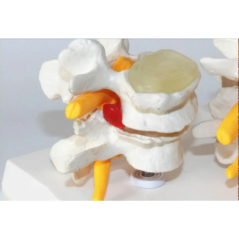 Skeleton Anatomical 4-stage Osteoporosis Vertebrae Anatomical Model Nursing Model Skin In Trauma Lumbar Degeneration Model