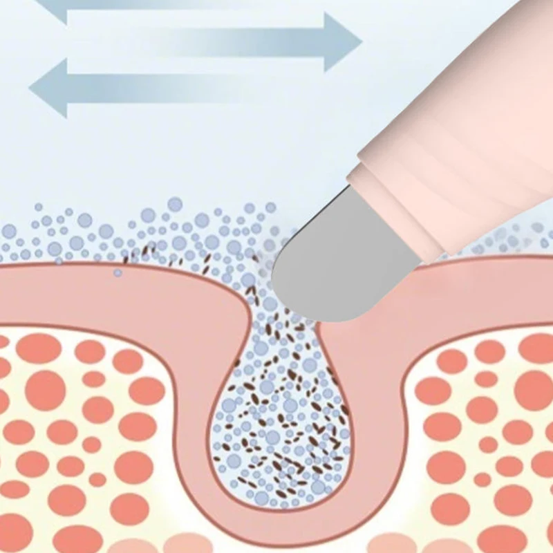 Ferramenta de remoção de cravo facial raspador facial para limpeza profunda rosto acne fundação espátula nariz removedor de cravo ferramenta de cuidados com a pele