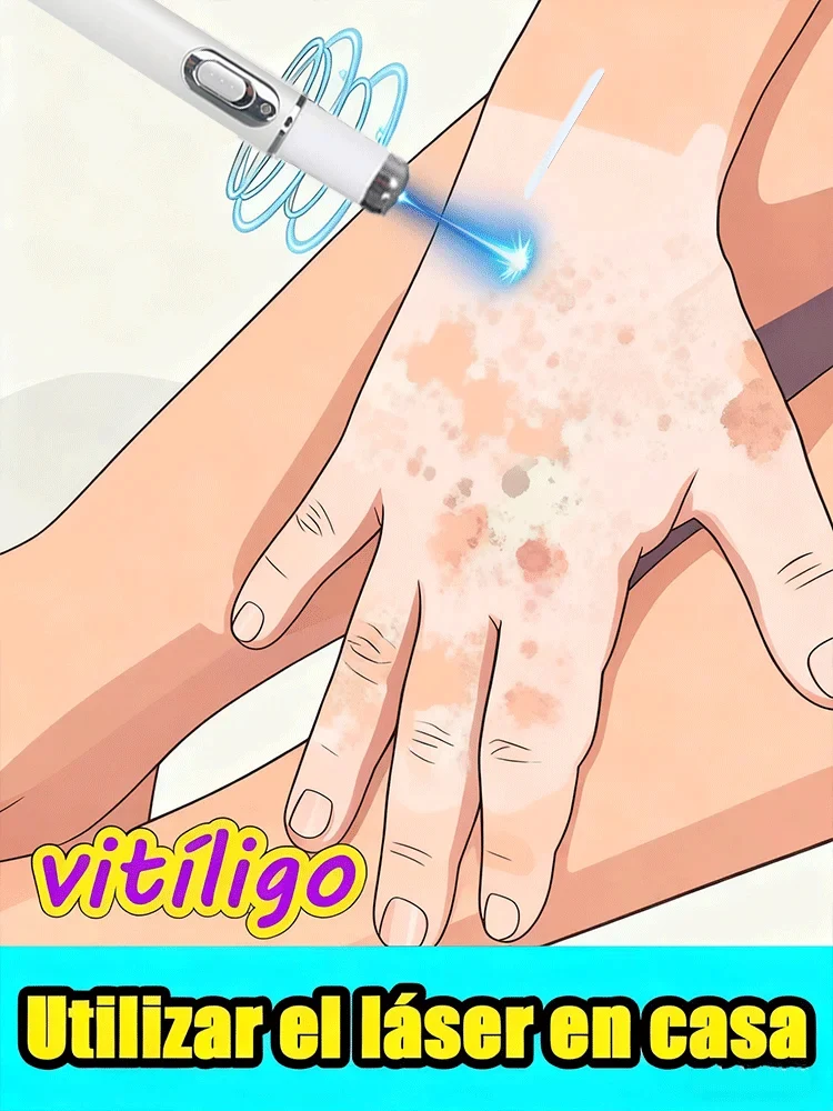 Generation-2 Blue light pen Says Goodbye To all Vitiligo In 7 Days