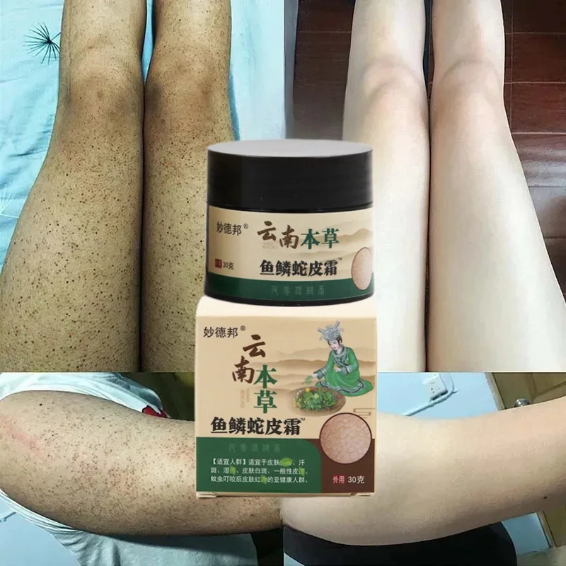 

Chicken Skin Repair Cream Body Whitening Curing Keratosis Follicle Pilaris Remove Thick Pores Dark Spot Moisturize Smooth Care