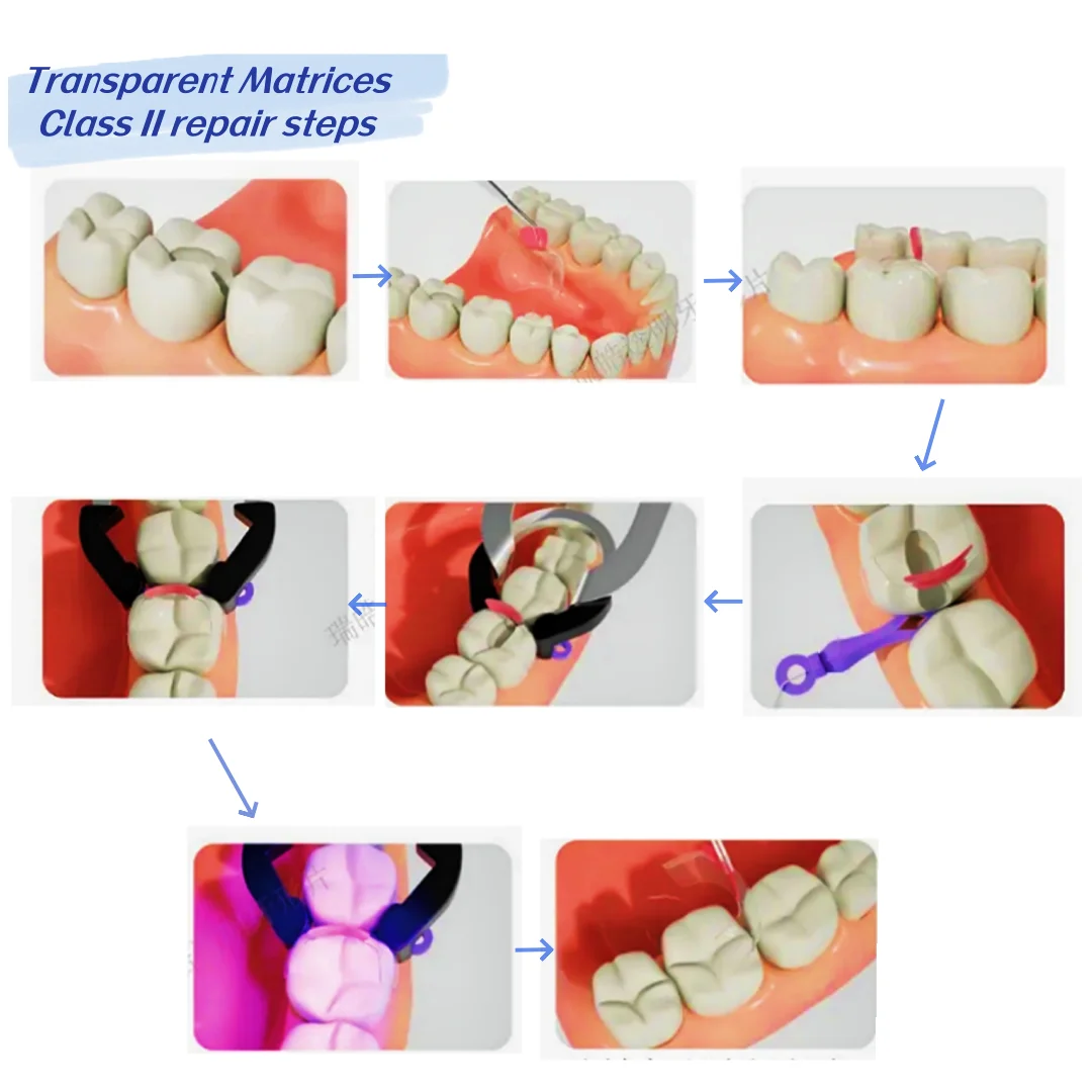 Dental Transparent Clear Matrix Anterior Rear Restoration BT Bow Matrices Contoured Fit BioClear 1.901/1.907/1.908/1.909