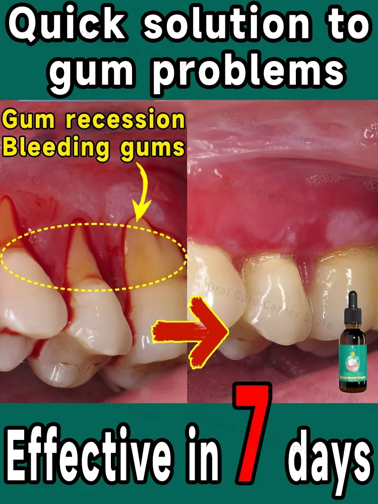 Protect gum health, quickly relieve toothache, repair damaged gums, and eliminate gum bleeding