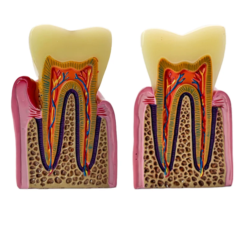 8 Times Dental Caries Teeth Model Periodontitis Case Analysis Teeth Model Dental Anatomy Teaching Studying Demonstration Model
