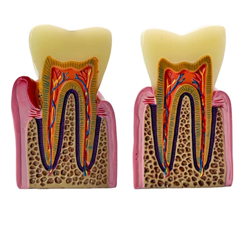 Imagen 2 del producto Modelo de dientes de caries dentales 8 veces, caja de periodontitis, análisis de dientes, modelo de enseñanza de anatomía Dental, estudio, modelo de demostración
