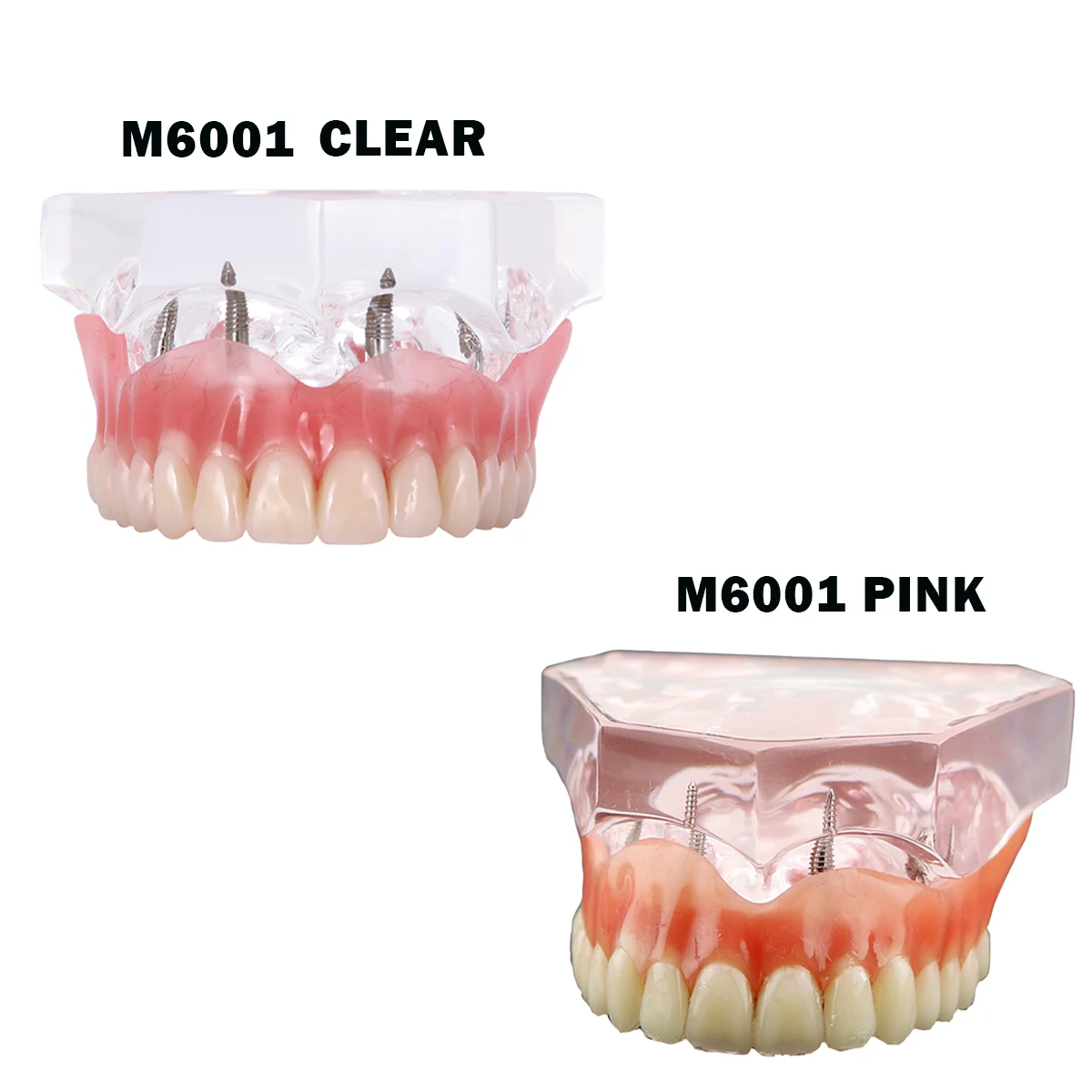 Dental Model Teeth Implant Restoration Dental Prosthesis Model   For Dentist Patient Communication Treatment Study Demo