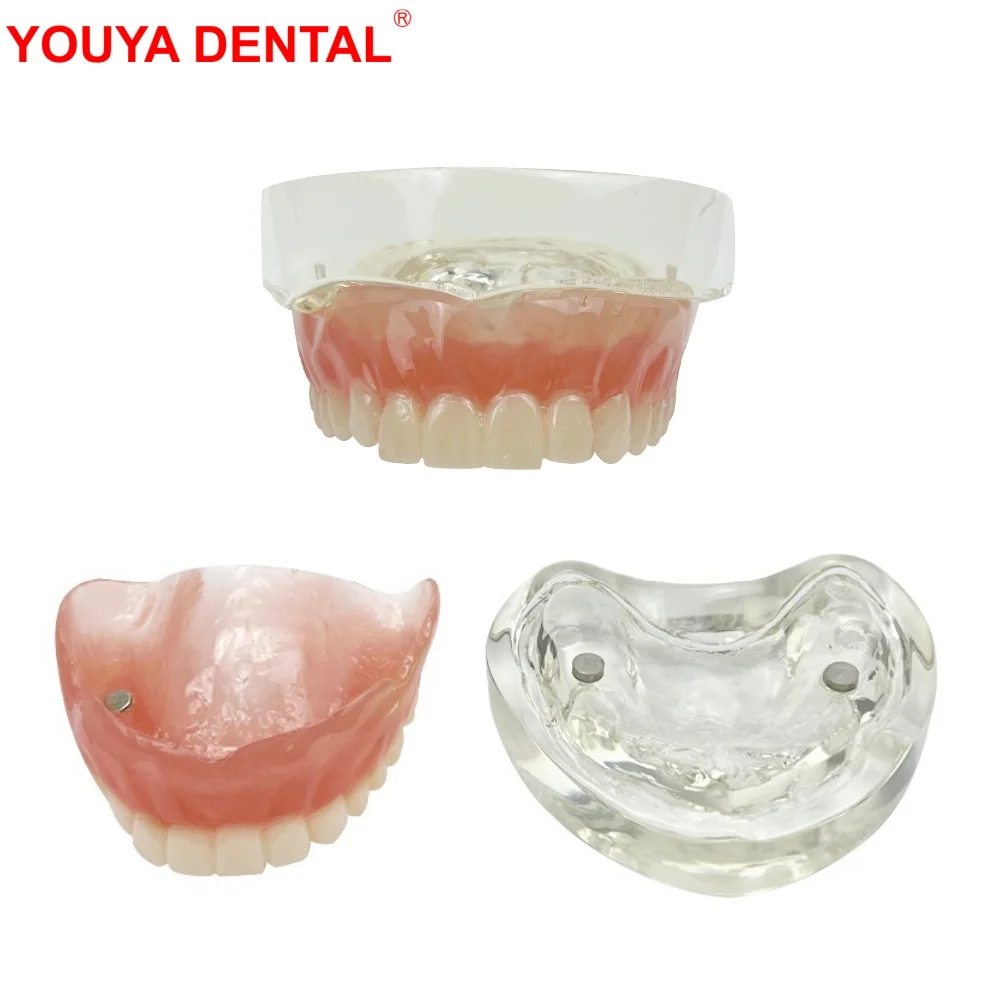 

Upper Jaw Dental Implant Model For Education Studying Dentistry Overdenture Maxillary Teeth Model Dental Teaching Tooth Models