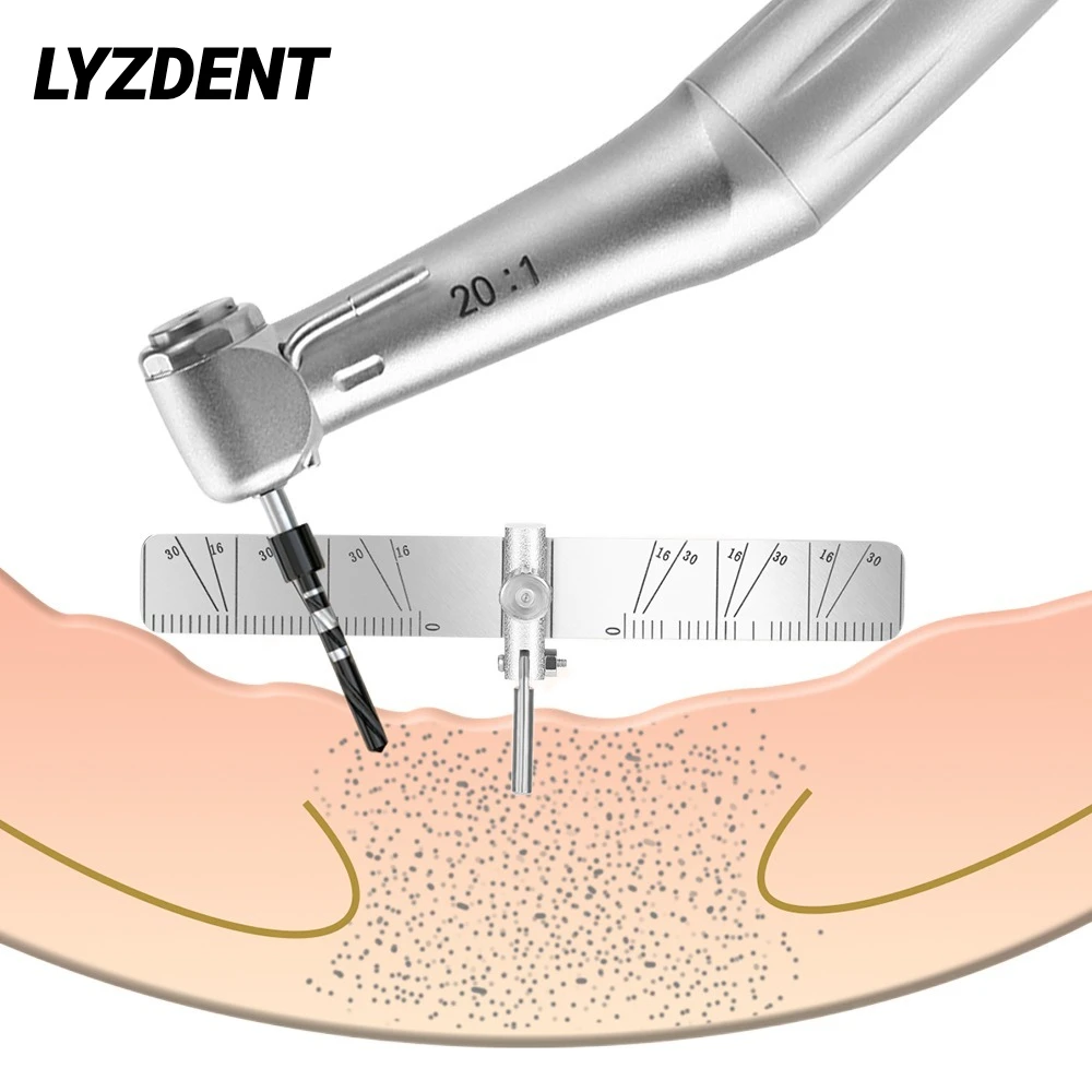 

1Pcs Dental Implant Locating Guide Dentist Tool For Surgical Planting Positioning Locator Gauge Autoclavable Lab Instrument Tool