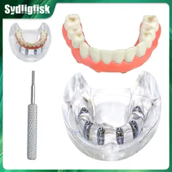 Dental Implant Model Teeth Model 6 Implant Overdenture Restoration Teeth Model Dentist Student Education Typodont Implant Model