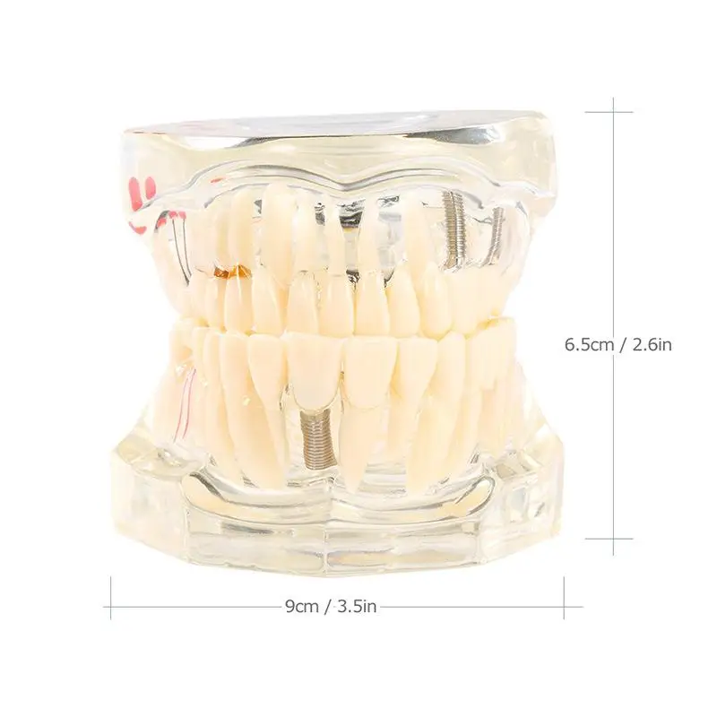 Dental Model Teeth Implant Restoration Bridge Teaching Study Medical Science Disease Dentist Dentistry Products Dental Gift