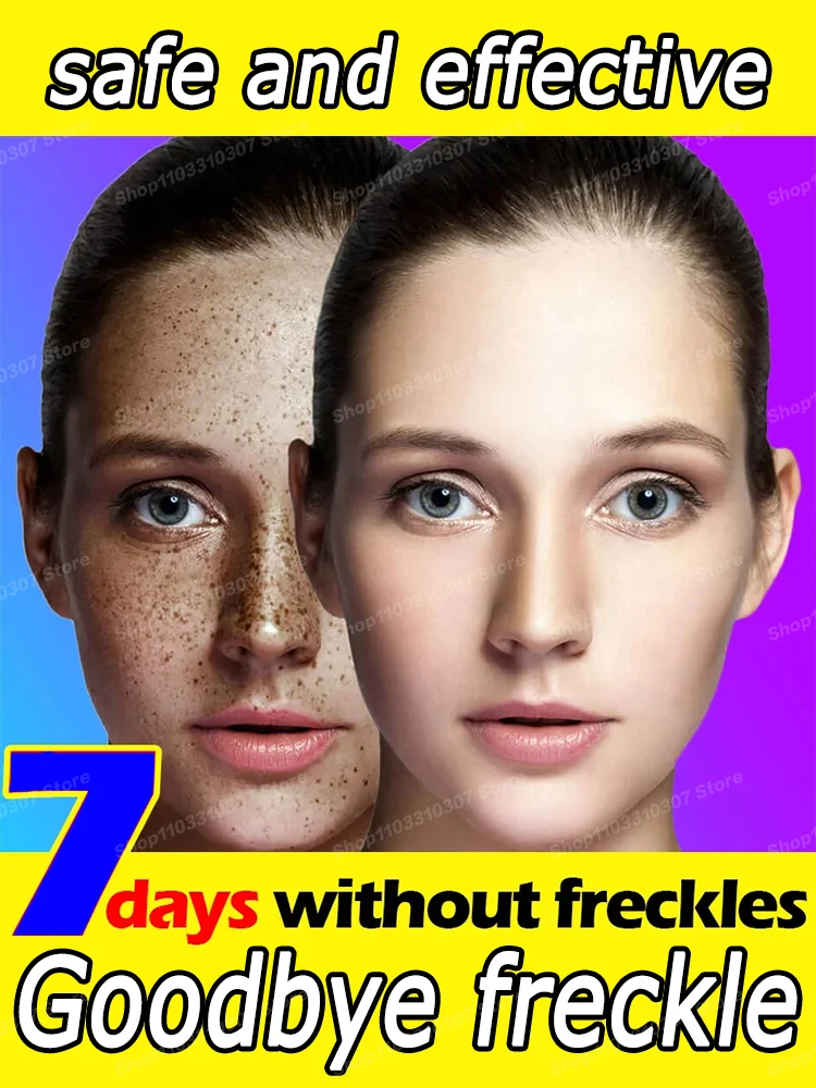 

Blu-ray pen Freckles Melasma Melasma Dark Spots on Face