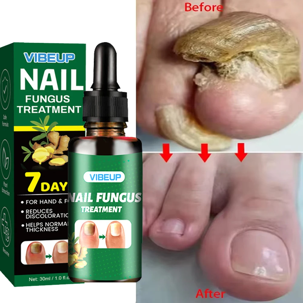 

7 Days Fungal Nail Treatment Serum Foot Nail Fungus Removal Repair Gel Anti Infection Paronychia Onychomycosis Foot Nails Care