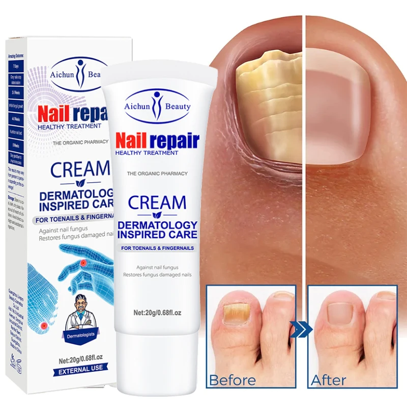 Crème de Traitement Efficace Contre les Champignons des Ongles, Sérum Anti-betection, Paronyamitié, Onychomycose, Gel de Soins