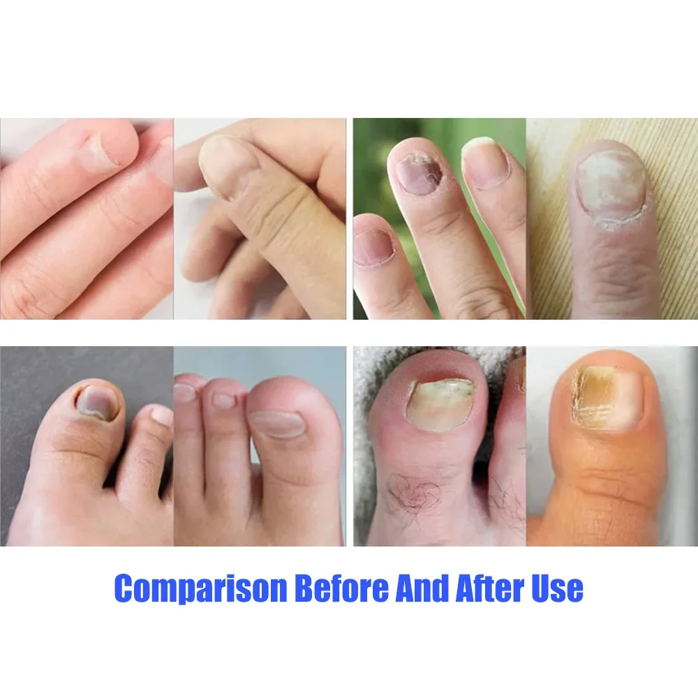 Fungal Nail Laser Device Repair Fast Toenail Nail Fungus Feet Treatment Fingernail Onychomycosis with Mushrooms Nails Foot Care