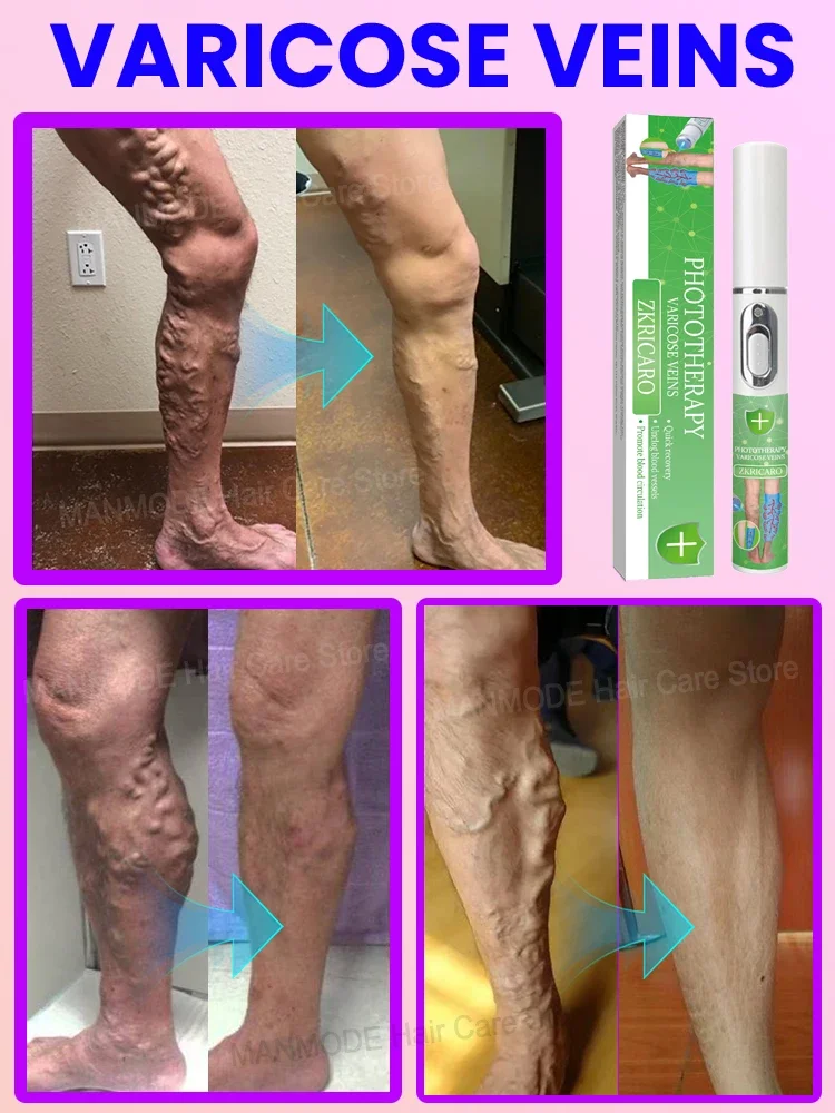 Laser Varicose Vein Products