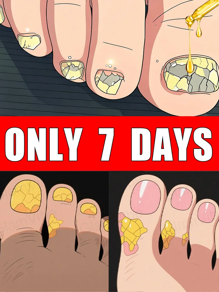 

Qᴜɪᴄᴋ Tʀᴇᴀᴛᴍᴇɴᴛ, Sᴀʏ Gᴏᴏᴅʙʏᴇ ᴛᴏ Fᴜɴɢᴀʟ Nᴀɪʟ Wᴏʀʀɪᴇs