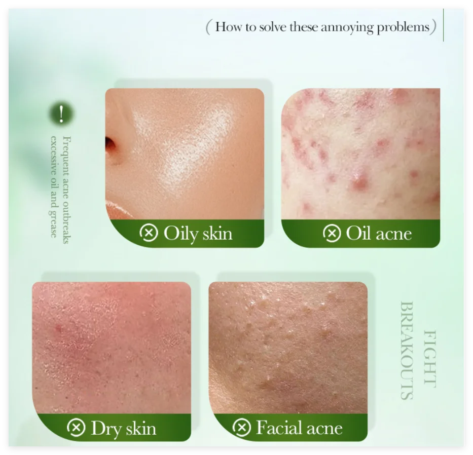 Salicylic Acid Acne Treatment Face Cream Repair Pimple Spots Deep Cleaning Pore Anti-acne Scar Oil Control Moisturizer Skin Care