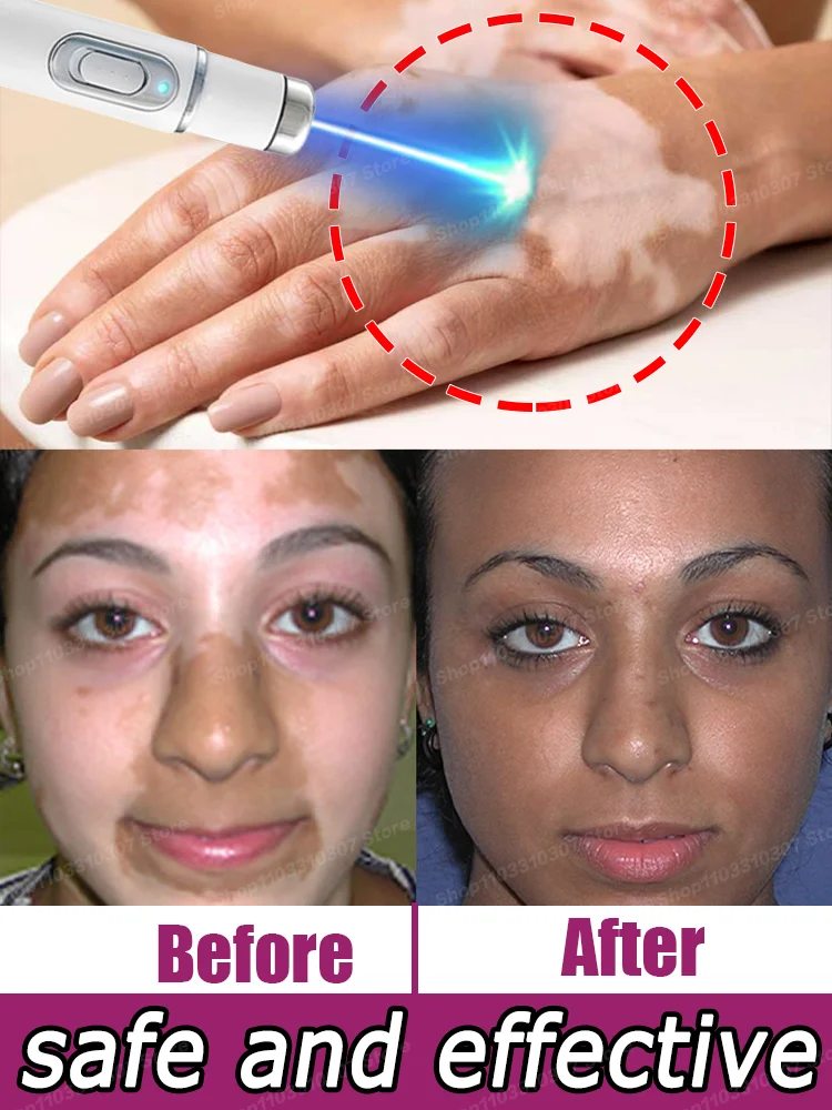 Vitiligo Quickly ImproveS White SpotS