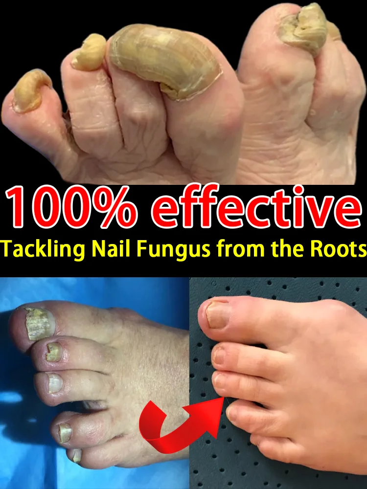 Nano-blue light repairs fungal nails