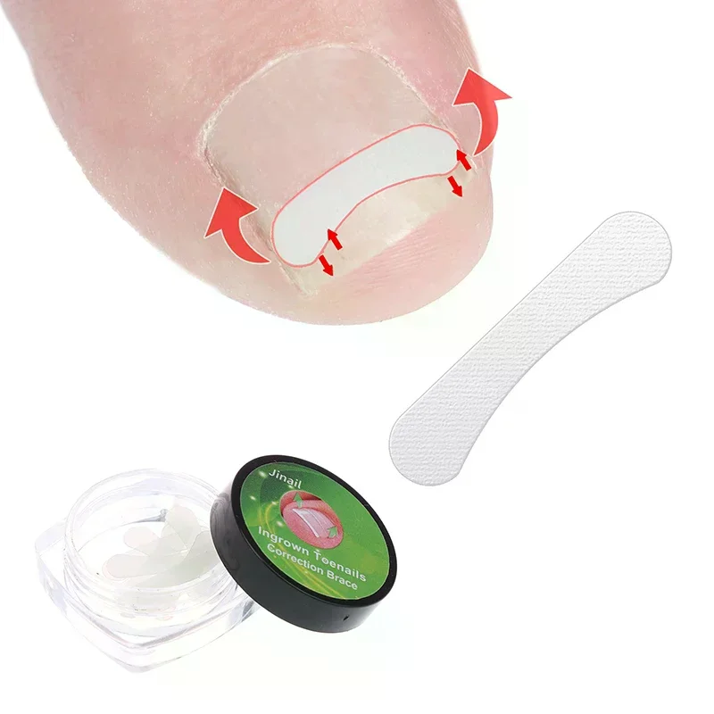 10Pcs Ingrown Toenail Correction Tool Straightening Clip Brace Ingrown Toe Nail Treatment Elastic Patch Sticker Pedicure Tool