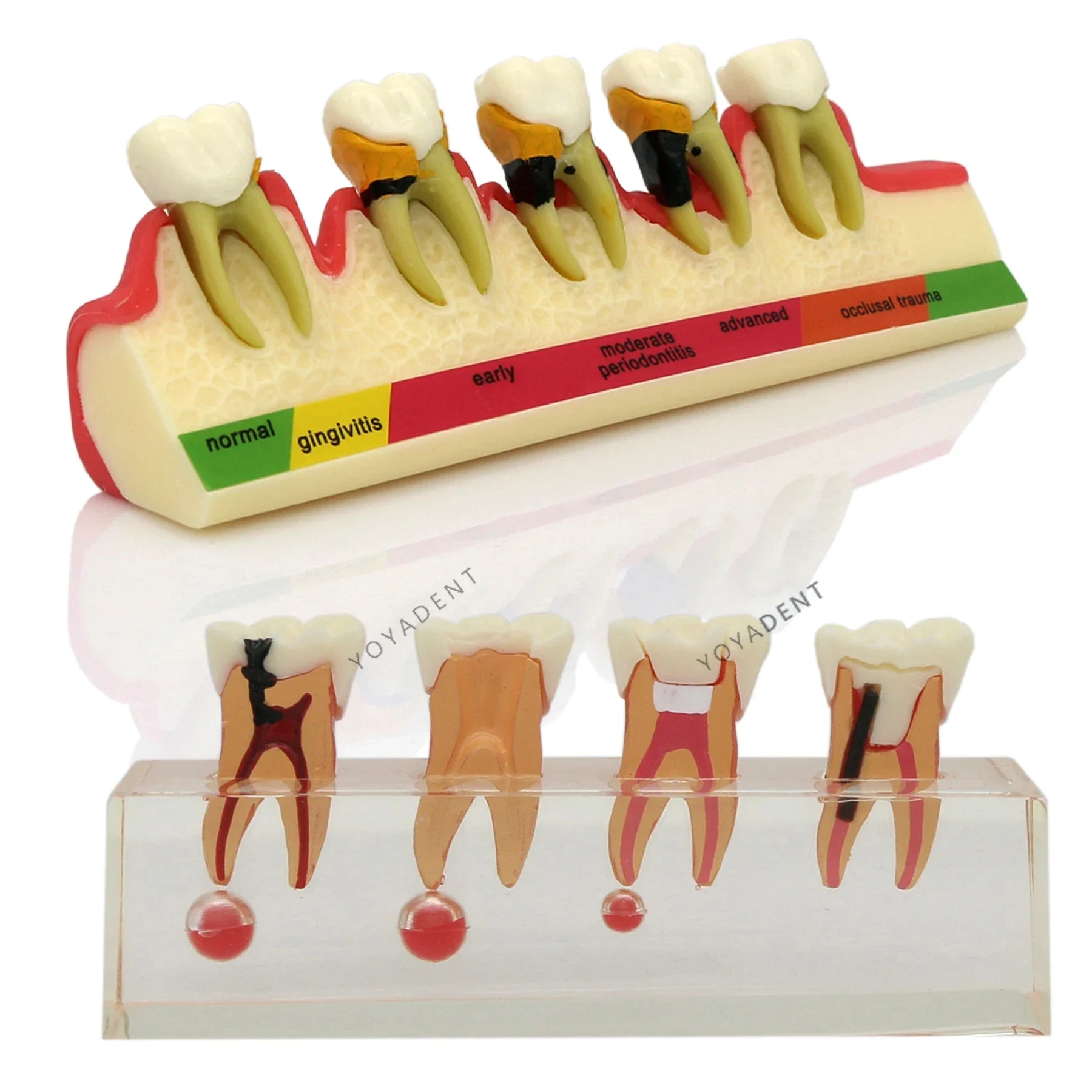 

Dental Teeth Model 4-Stages Endodontic 5 stages Periodontal Disease Progress Root Canal Treatment For Dentist Teaching Studying