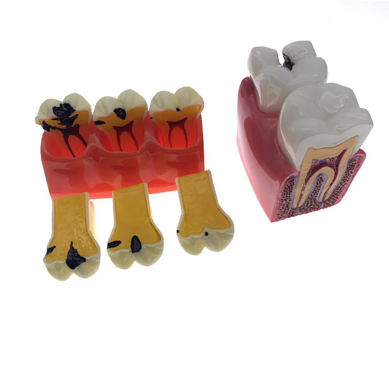 Dental Caries Teeth Comparation Model Dental Study Education Demonstration Teaching Model