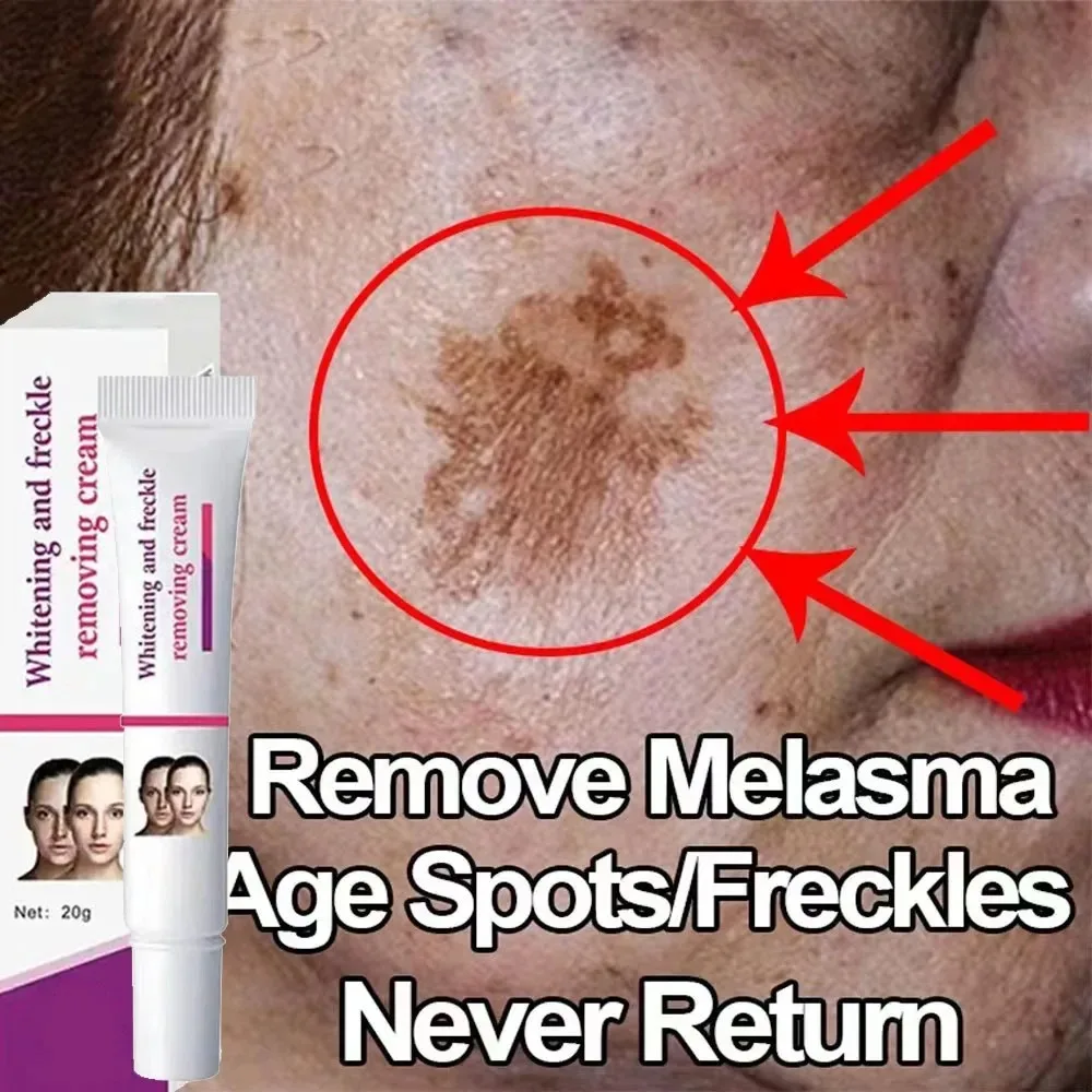 Creme De Remoção De Sardas, Remova Manchas Faciais, Mancha Escura Da Pele, Manchas Da Idade Do Melasma, Manchas Solares, Clareamento E Creme De Remoção De Sardas