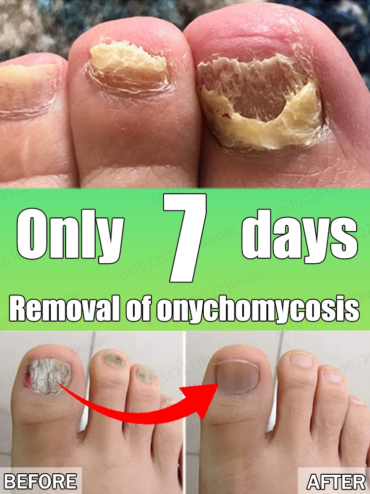

Say goodbye to onychomycosis and quickly remove onychomycosis