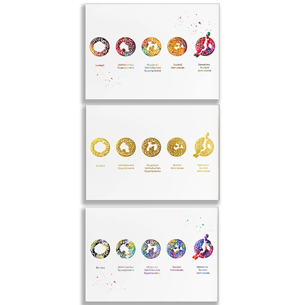 Normal breast and breast cancer types anatomy ductal carcinoma poster medical science gold art print