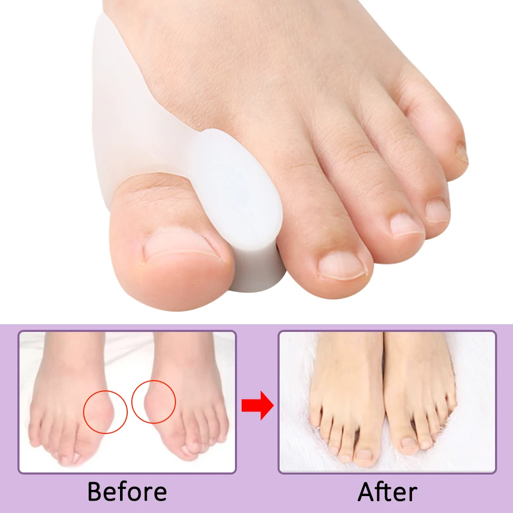 Pexmen 2/4/8Pcs Gel Big Toe Separator Bunion Corrector Pain Relief Hallux Valgus Straighter Orthopedic Toe Protector Spacer