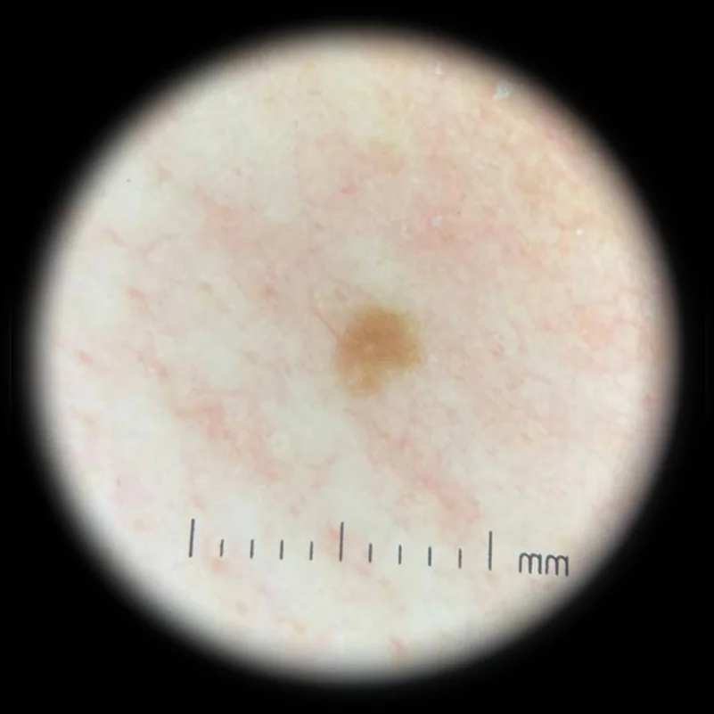 IBOOLO DE-300ใช้ Polarized Dermestid สำหรับ Dermatology