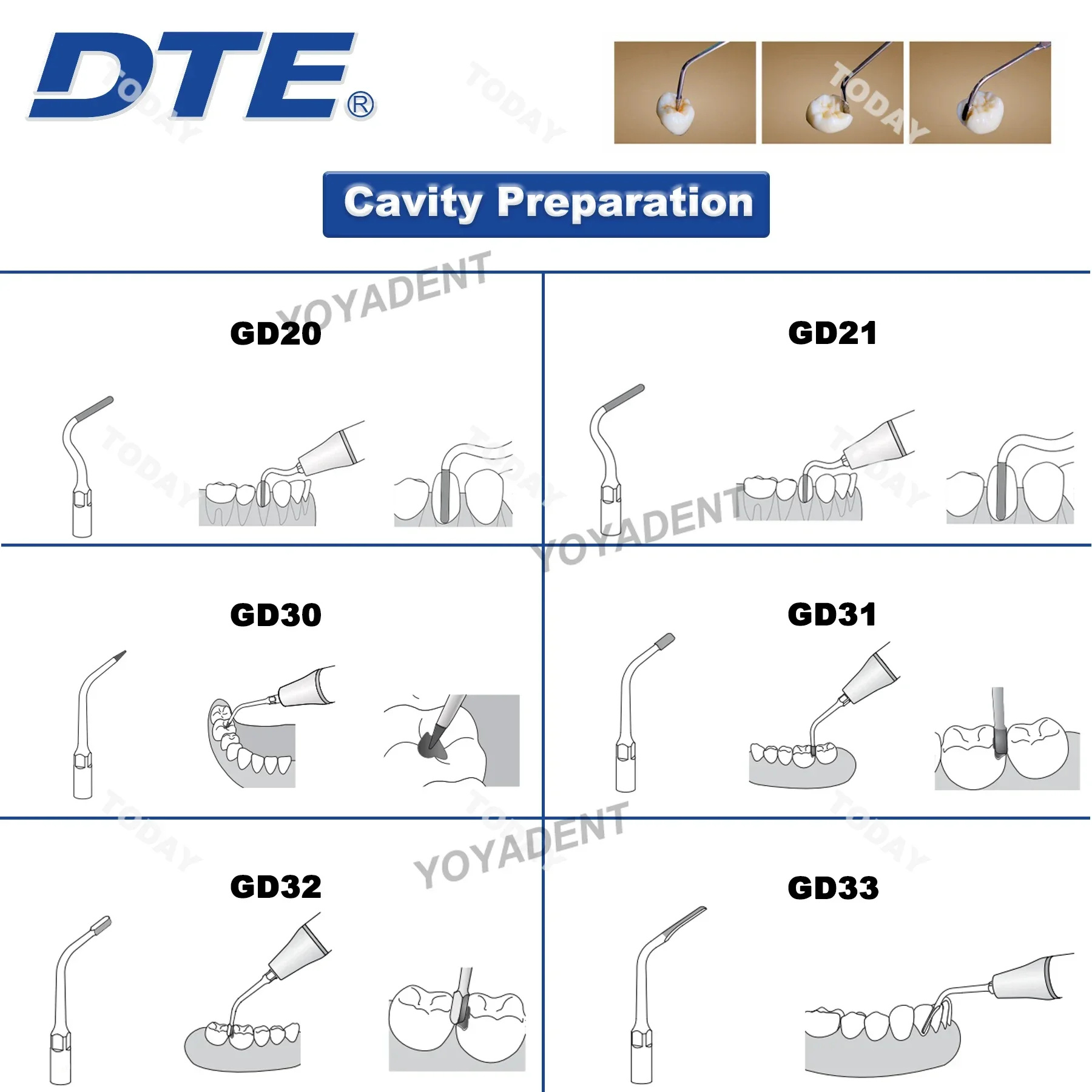 Woodpecker DTE Dental Ultrasonic Scaler Tip For Cavity Preparation Fit SATELEC ACTEON GD20 GD21 GD30 GD31 GD32 GD33