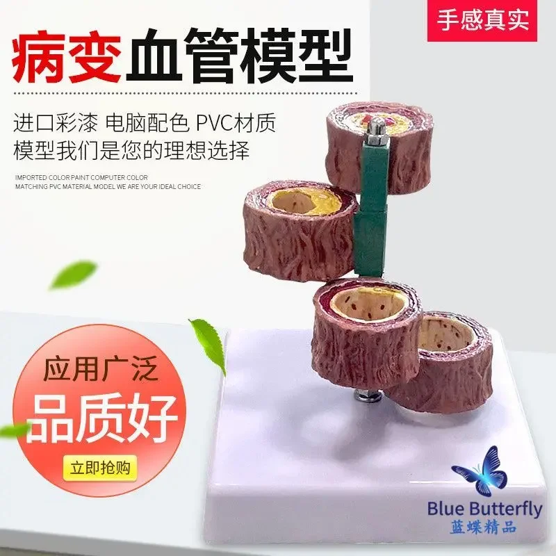 Blockage Of Blood Vessels, Blood Concentration, Fat Pathology, Blood, Human Vascular Pathology, Anatomical Model
