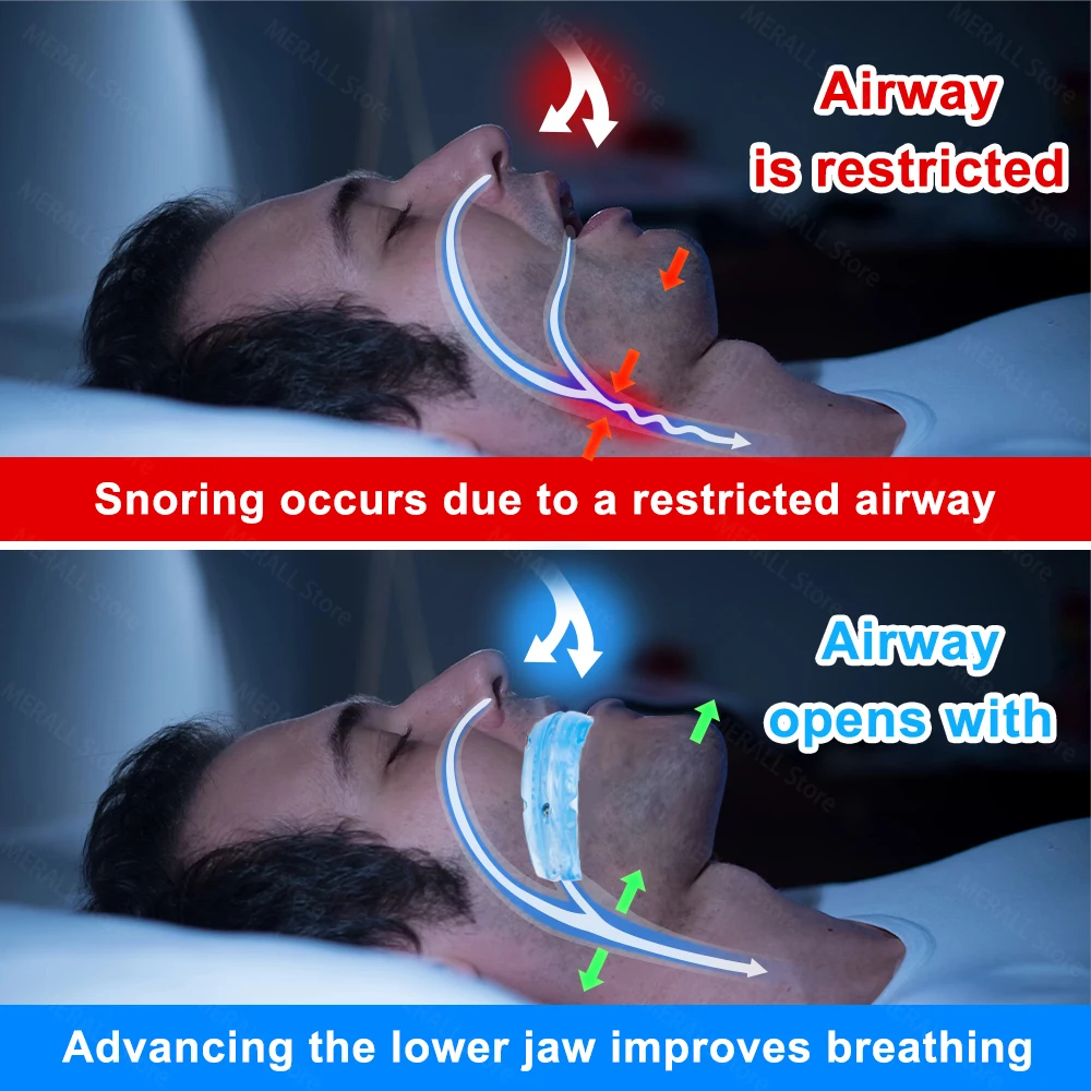 Anti Snoring Mouth Guard Adjustable Anti-Snoring Mouthpiece Sleeping Devices Bruxism Snoring Stopper Improve Sleep Mouthpiece