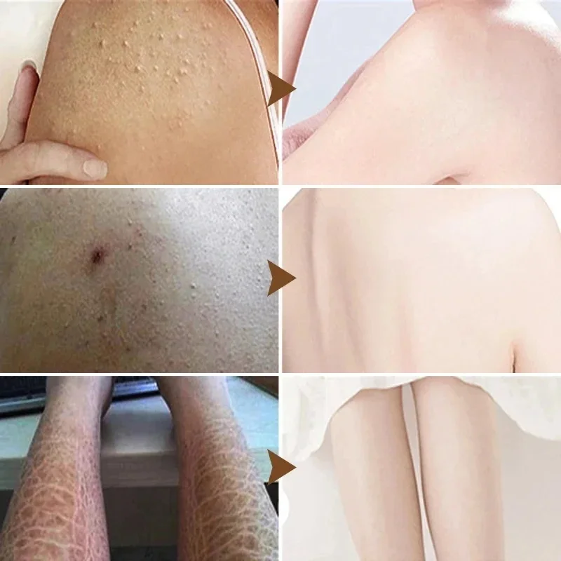 Queratose pilaris reparação tratamento creme esfoliante remoção pele de frango limpeza manchas acne hidratante suave cuidados com a pele do corpo