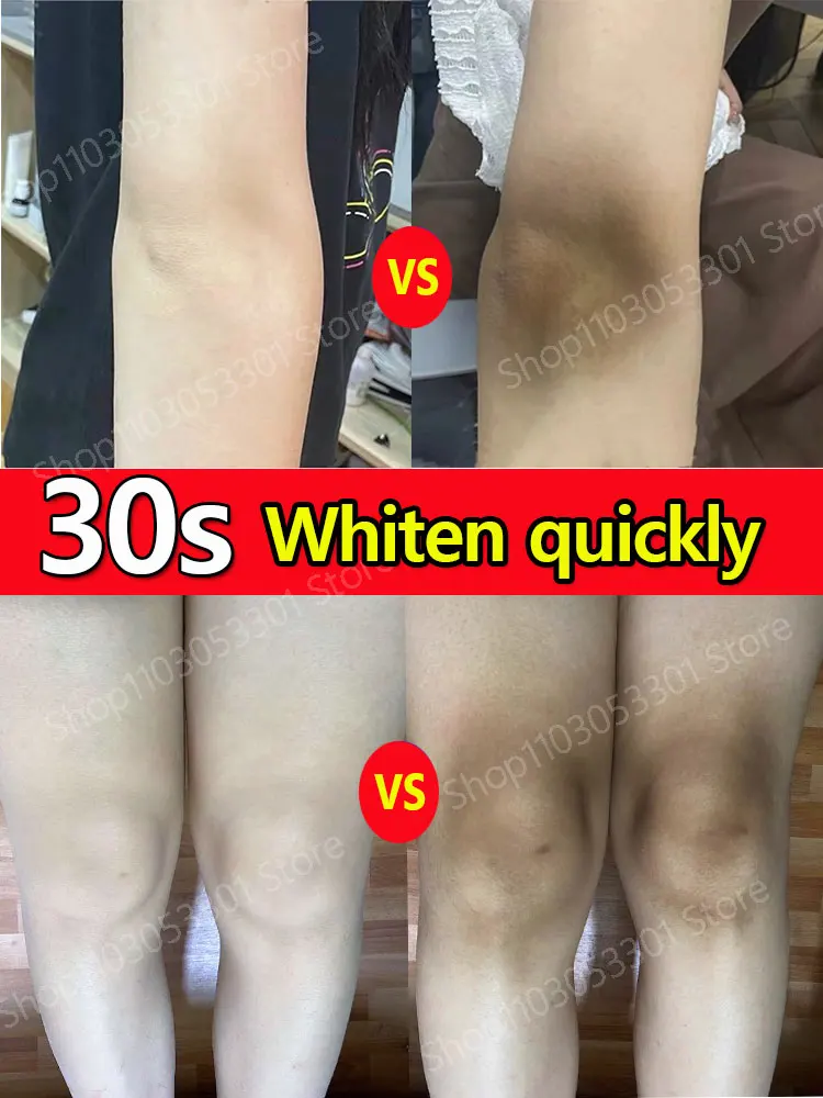 

Body Whitening Cream Armpits Legs Knees Elbows Armpits Whitening Cream Improves Darkness Removes Dark Spots Melanin Brightens Sk