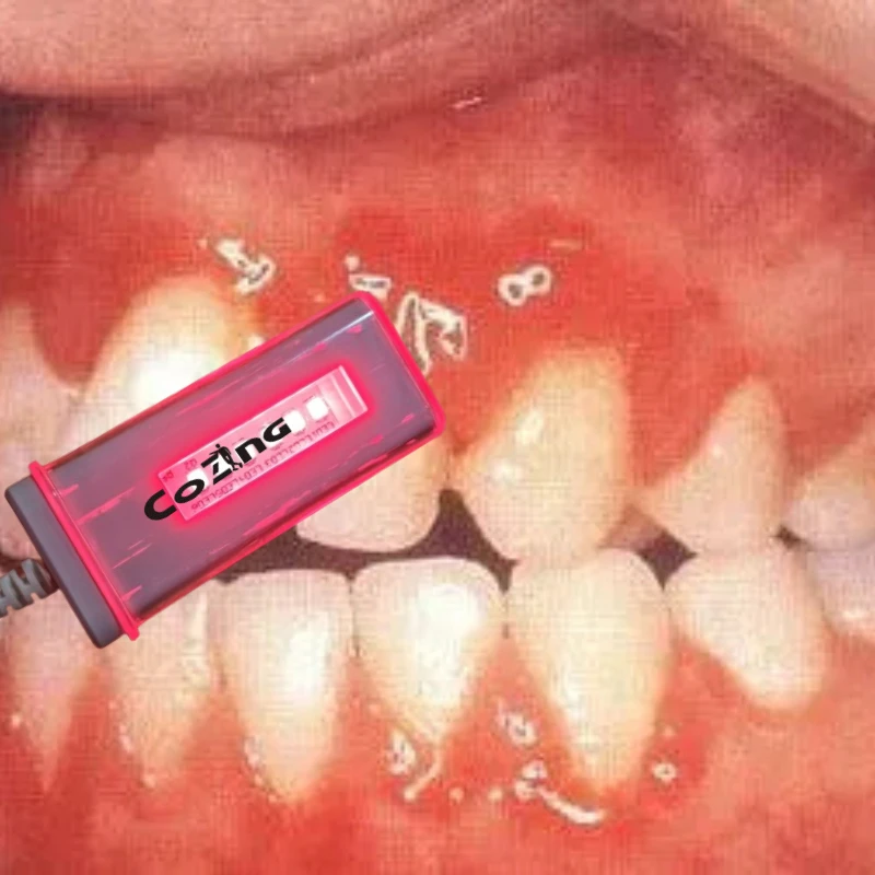 

Лазер для полости рта с питанием от USB для семейного ухода за здоровьем детей, храпом и безопасным воспалением десен для взрослых