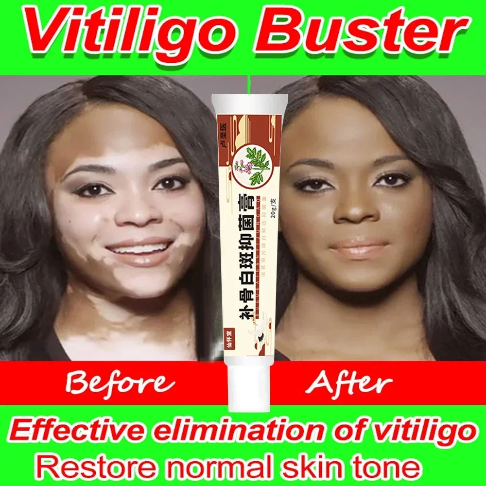 Vitiligo Repair Get Rid Of Ringworm White Spots Get Rid Of Skin Vitiligo Eliminate Vitiligo Better Body Skin