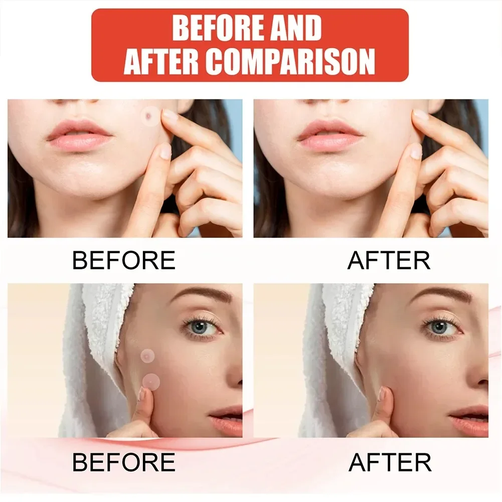 Pimple Patch Acne Invisible Acne Removal Skin Care Stickers Concealer Face Spot Beauty Makeup Tools facial skincare skin care