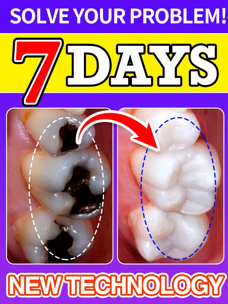 

Cavity Repair Solution Recommended by Dentists: Deep Restoration, Prevent Future Decay, and Enjoy Worry-Free Chewing!