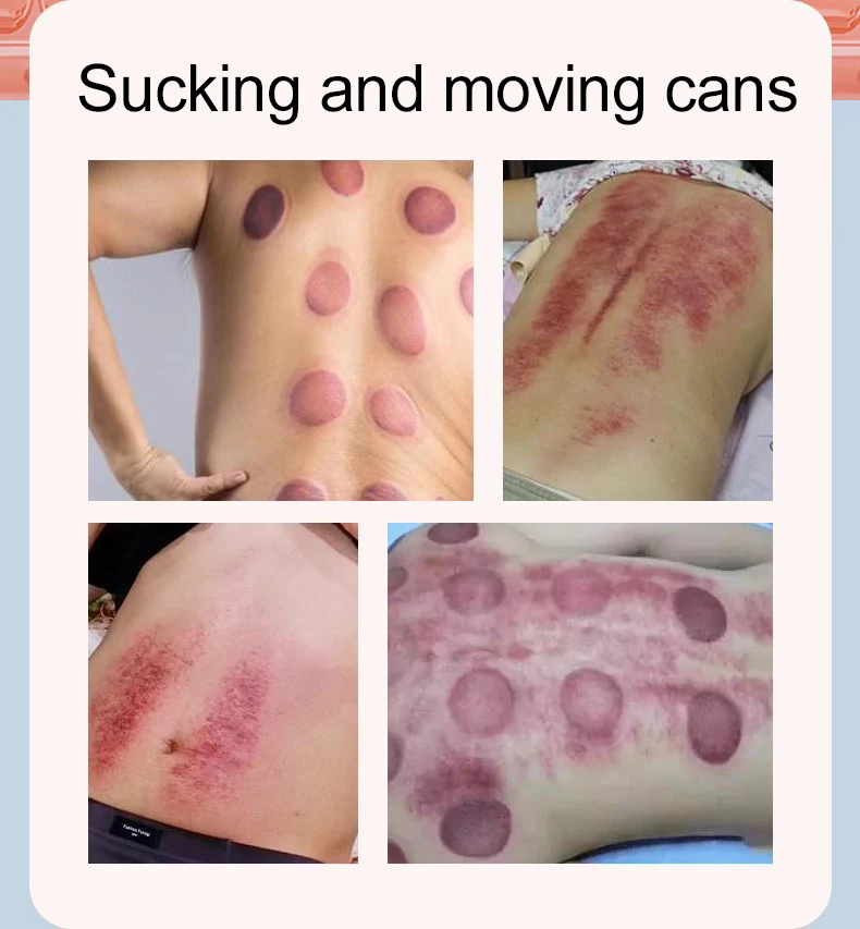 전기 스크래핑 기구, 경락 마사지 삼중 마스터, 흡입기, 근막 나이프, 부항 미용실