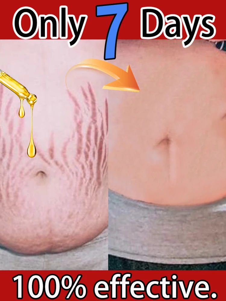 

Eelhoe 1set Pregnancy Skin Care Set Obesity Stretch Mark Remover Smooth Skin Tightening Maternity Postpartum Repair Care Set