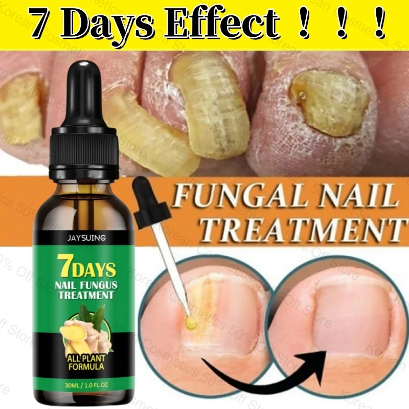 

Fungal Nail Treatment Essence Oil Nail Fungus Laser Device Repairs Toenail Fingernail Onychomycosi Anti Infection Hand Foot Care