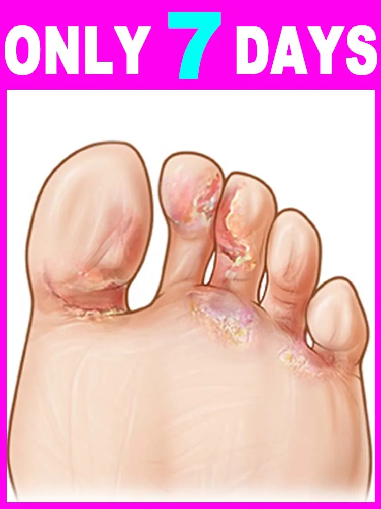 

Hᴇᴀʟɪɴɢ Fᴏᴏᴛ Uʟᴄᴇʀs, Tɪɴᴇᴀ Pᴇᴅɪs, Aɴᴅ Fᴜɴɢᴀʟ Iɴғᴇᴄᴛɪᴏɴs Tʜᴇ Fᴇᴇᴛ Healthy beautiful feet