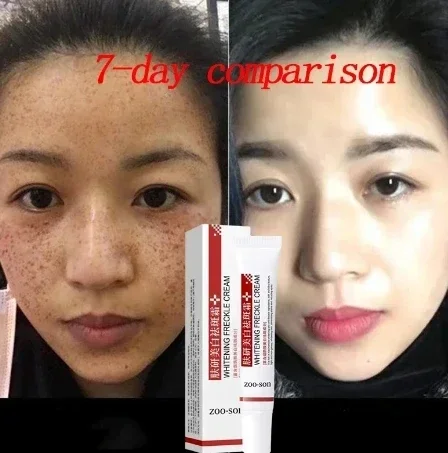 

Whitening Freckle Cream Remove Dark Spots Anti Freckle Face Creams Niacinamide Fade Pigmentation Melasma Brighten Skin Care 20g