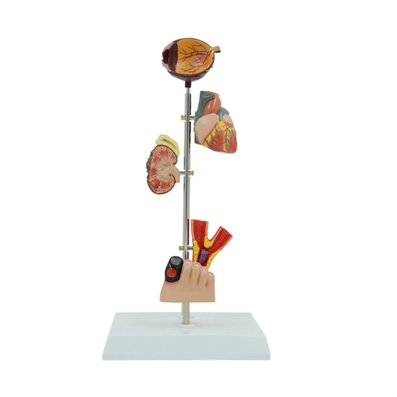 Anatomical Pathological Kidney Model, Diabetes Pathology Demonstration Anatomy Model Human Kidney Blood Vessel Model X3UF