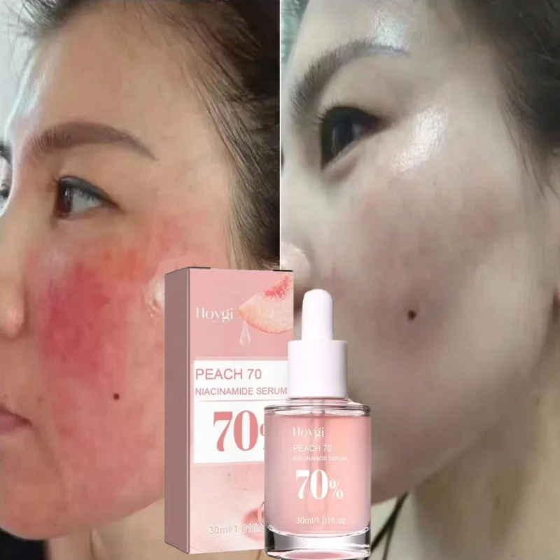 

Facial Redness Repair Essence Improve Sensitive Skin Dryness Moisturizer Hydrating Sooth Lotion Removal Rosacea Korean Cosmetics